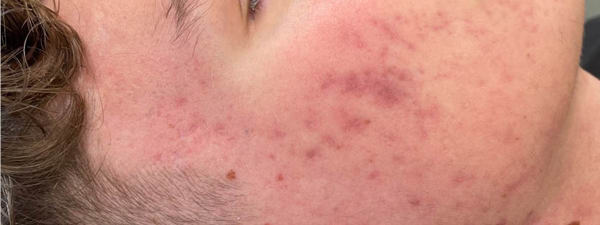Acne3x