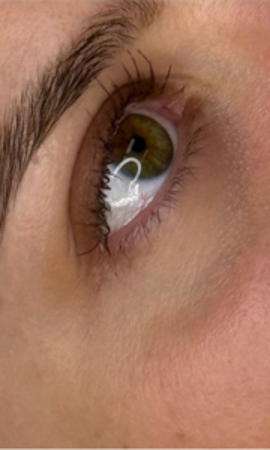 Microneedling Onder Ogen Resultaat