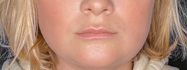 Lipfillers 32 (1)