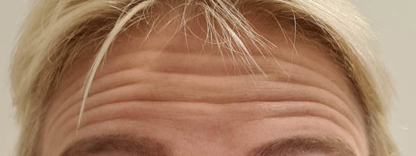 Botox Voorhoofdrimpels