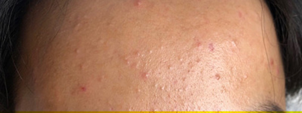 Acne 3X
