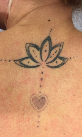 Tattoo Verwijderen Resultaat Voor