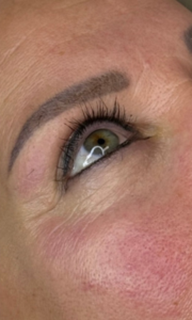 Resultaat Onder Oog Behandeling 2