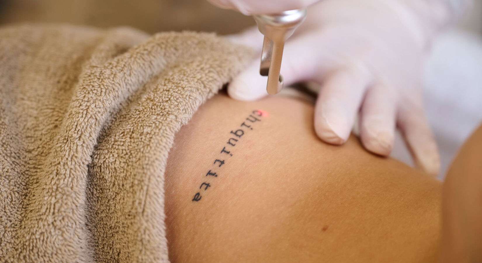 Tattoo Laseren Amsterdam (3)