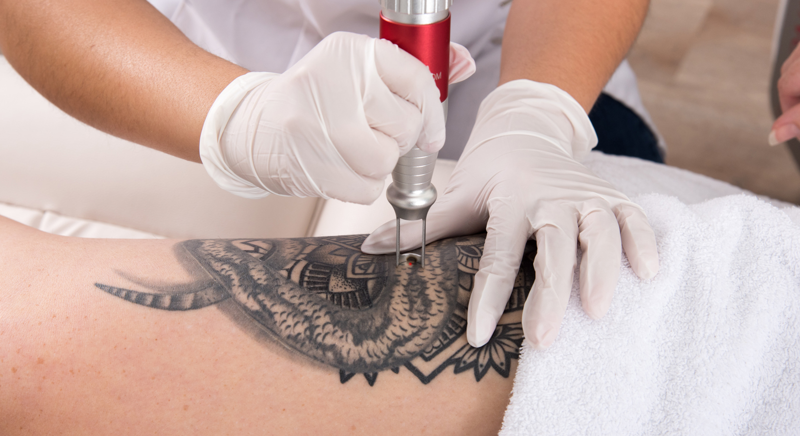 Alles Over Tattoo Verwijderen