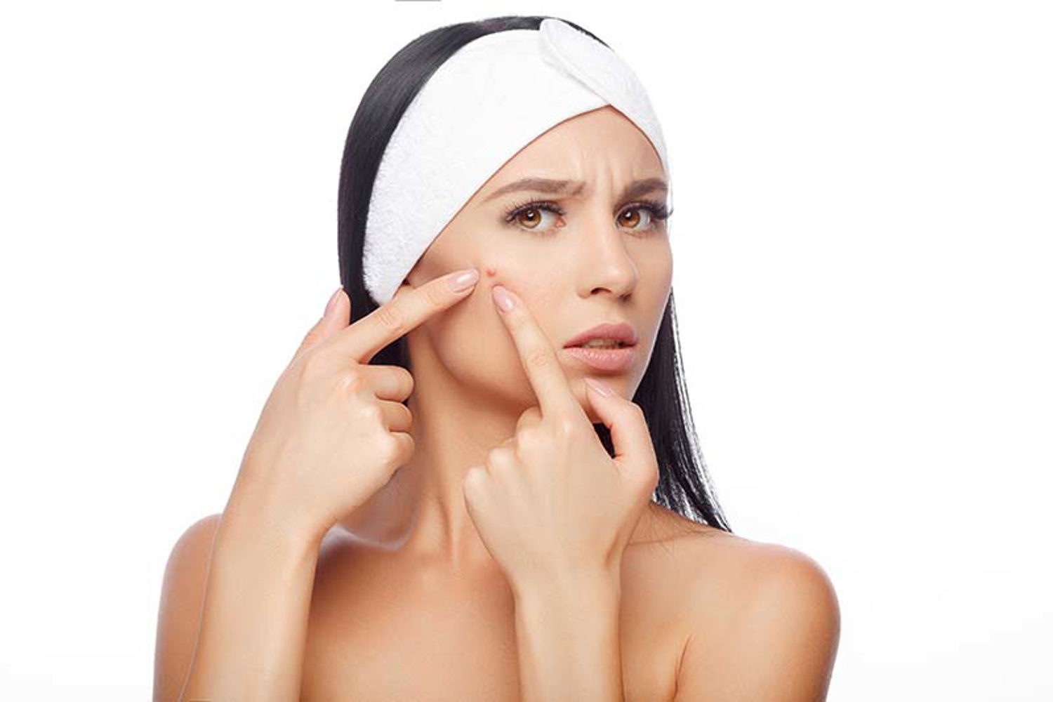 Acne Vulgaris (1)