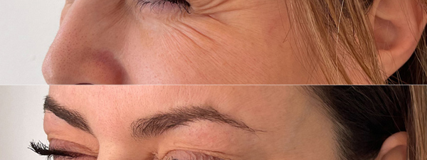 Botox Kraaienpootjes