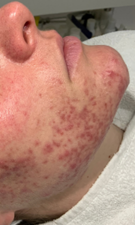 Acne Voor