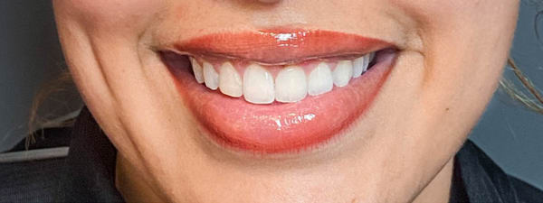Botox Gummysmile 2