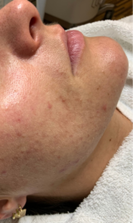 Acne Na Productgebr, Acne Prone Peels En 1X Lumecca