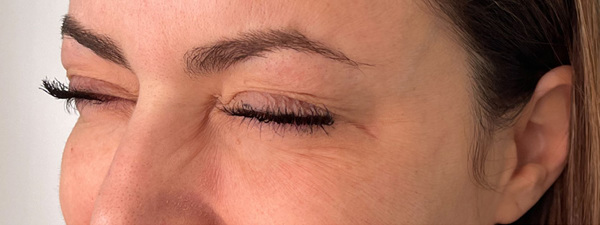 Botox Kraaienpootjes2