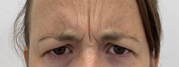Botox Frons 3