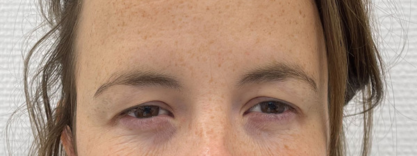 Botox Frons 4