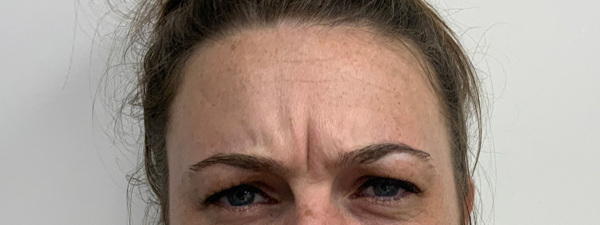 Resultaat Injectable Bocouture Botox Behandeling Van Frederique 14 2 OOK VOOR EXTERN Voor