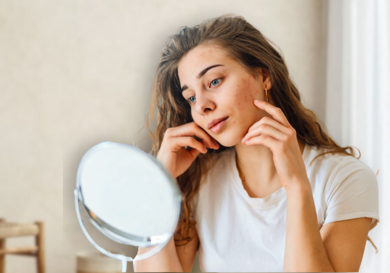 Rosacea Behandeling