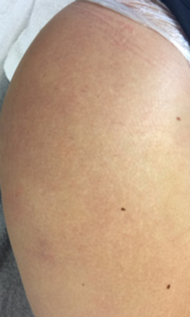 Striae 22