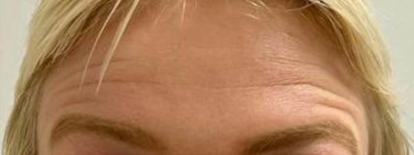 Botox Voorhoofdrimpels2