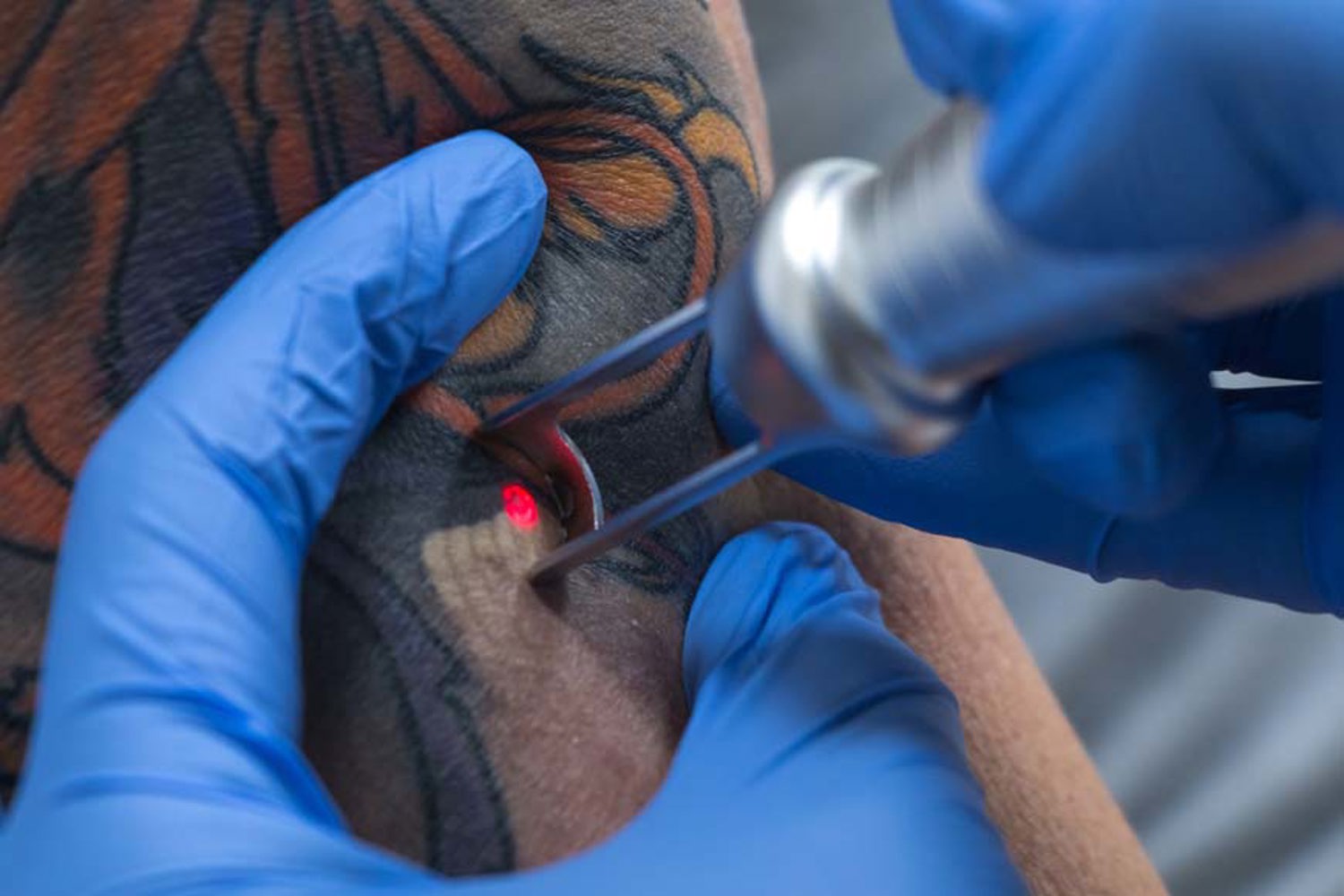 Tatoeage Verwijderen