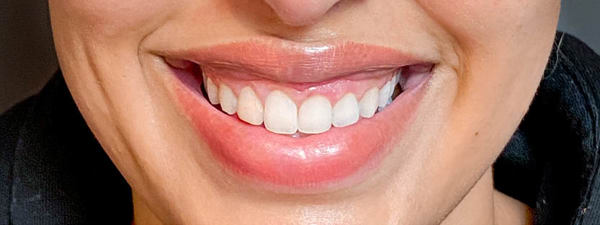 Botox Gummysmile (1)