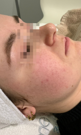 Acne Resultaat 8 Na