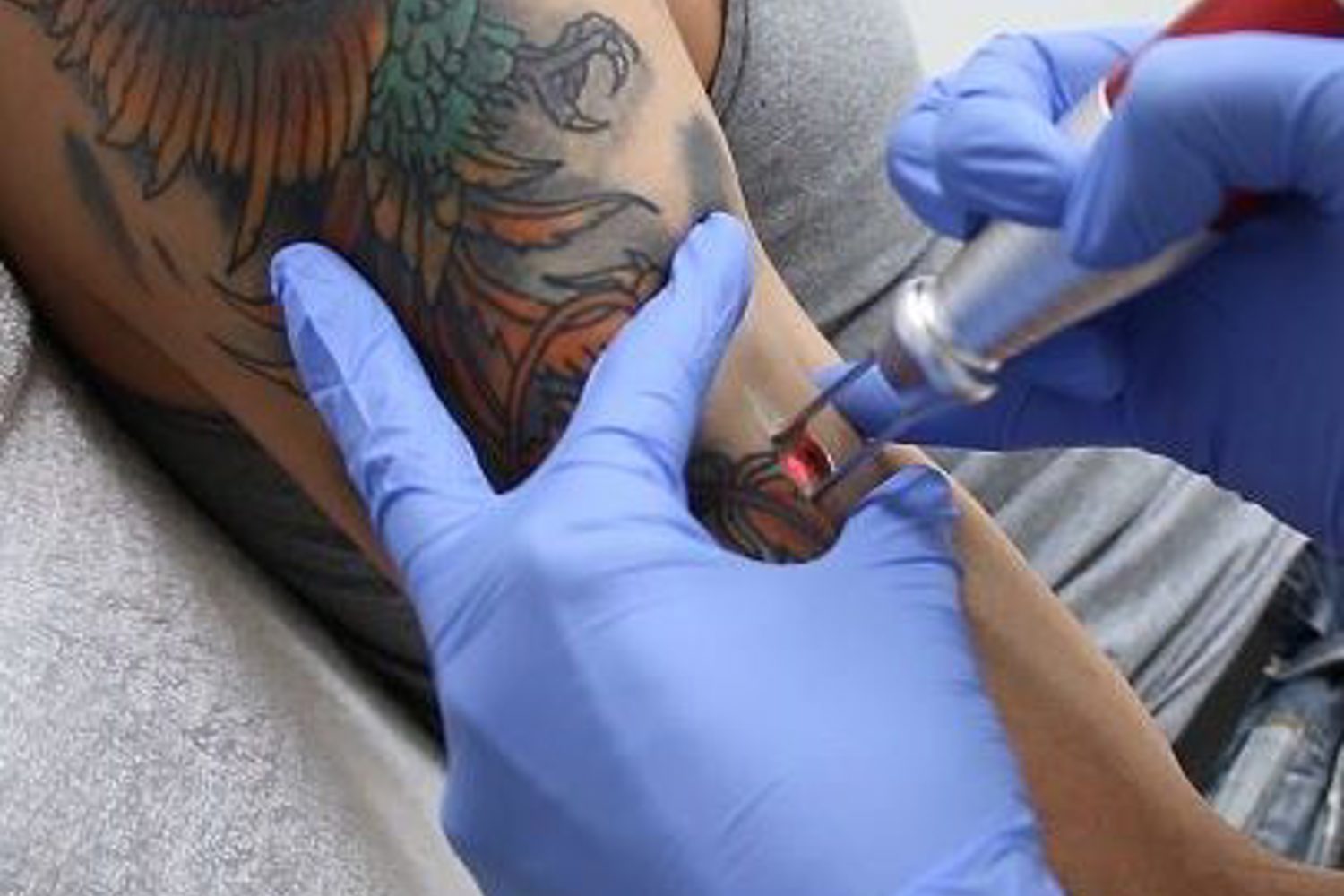 Tattoo Laseren