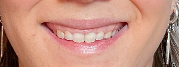 Alles over een gummy smile