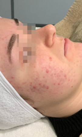 Acne Resultaat 8 Voor