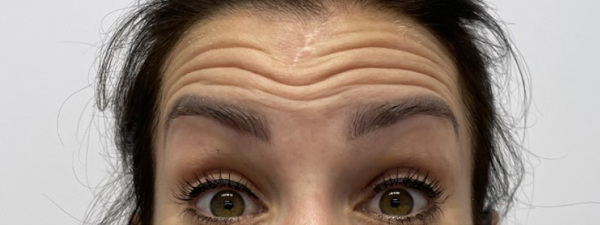 Botox Voorhoofd Rimpel