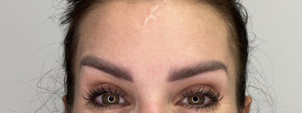 Botox Voorhoofd Rimpel 2