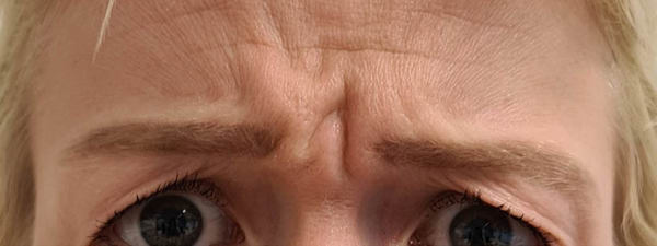 Botox Fronsrimpel