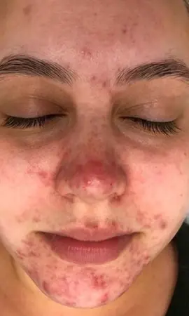 Rosacea Resultaat Voor