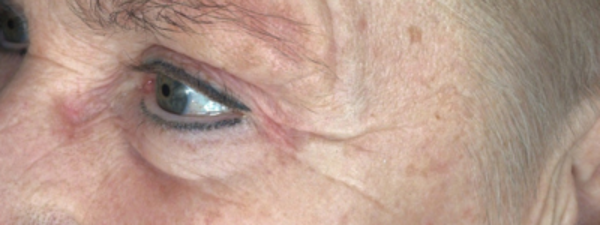 Resultaat Microneedling En Morpheus Voor
