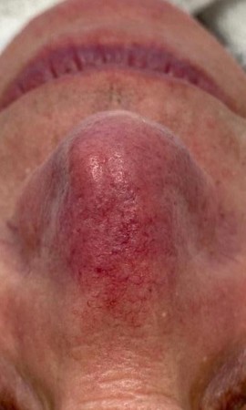 Couperose Neus Voor