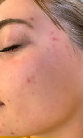 Acne Verwijderen Gezicht