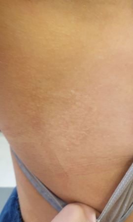 tatoeage laseren resultaat