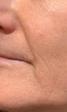 Resultaat Morpheus8 1 2