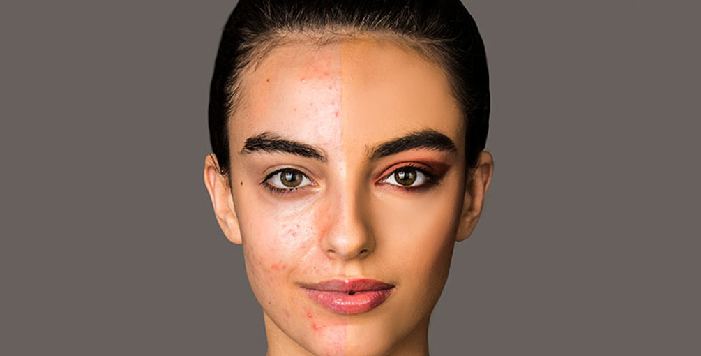 Acne Make Up