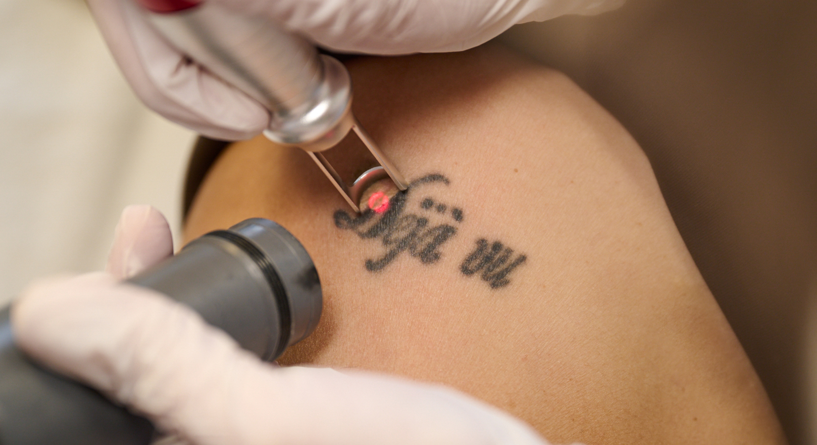 Spijt Van Je Tatoeage Wat Nu