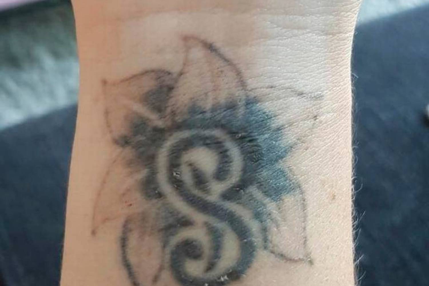 Tattoo 1Laser