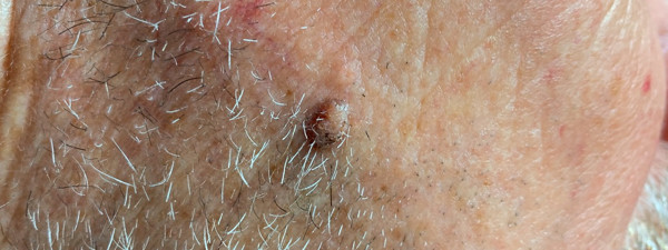 Coagulatie 2Behandelingen