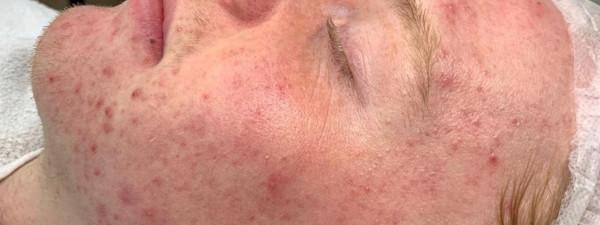 Acne 5X