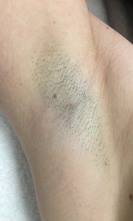 Resultaat Laserontharen Oksels