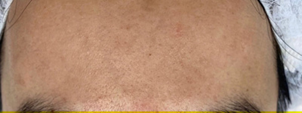 Acne 3X2
