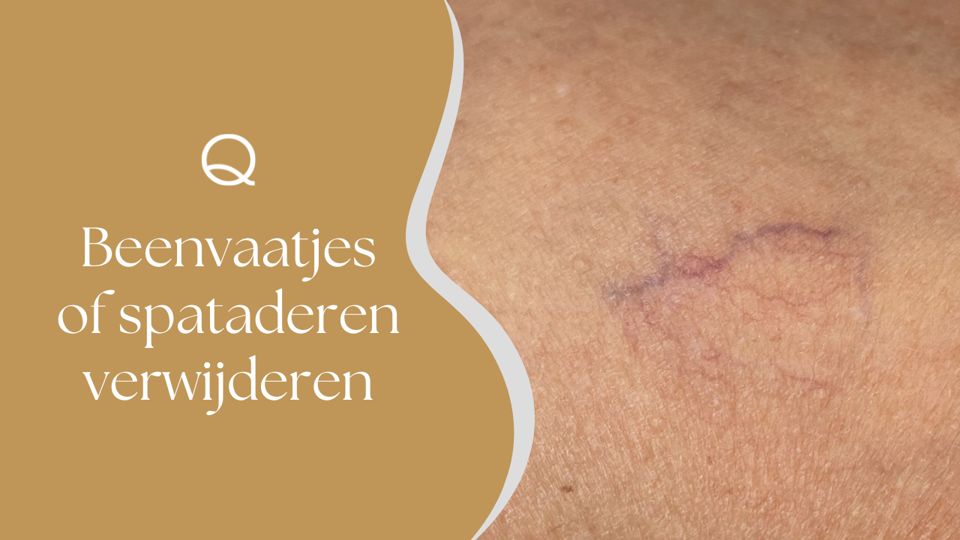 Beenvaatjes Of Spataderen Verwijderen (1)