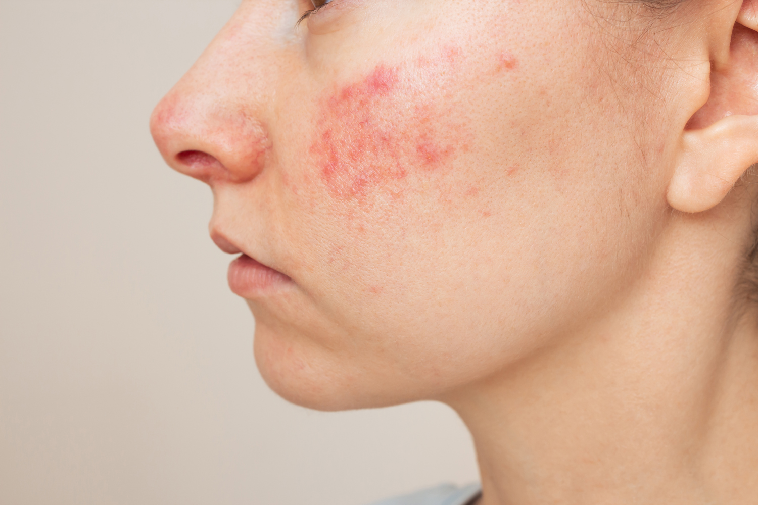 Couperose Is Een Andere Naam Voor De Huidaandoening Rosacea