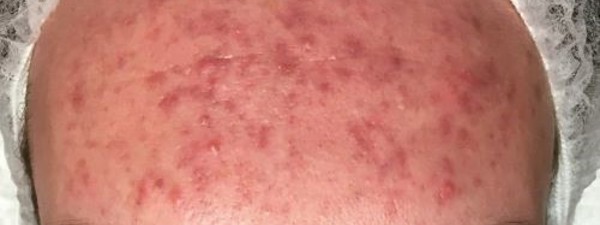 Acne Behandeling Resultaat (2)