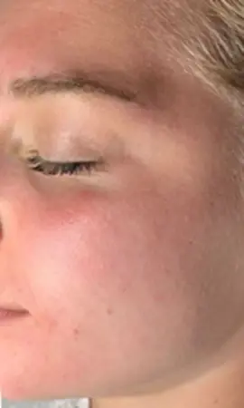 Acne Peeling (1)
