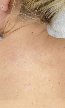 Tattoo Verwijderen Resultaat Na4beh