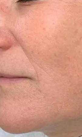Resultaat Morpheus8 2 2