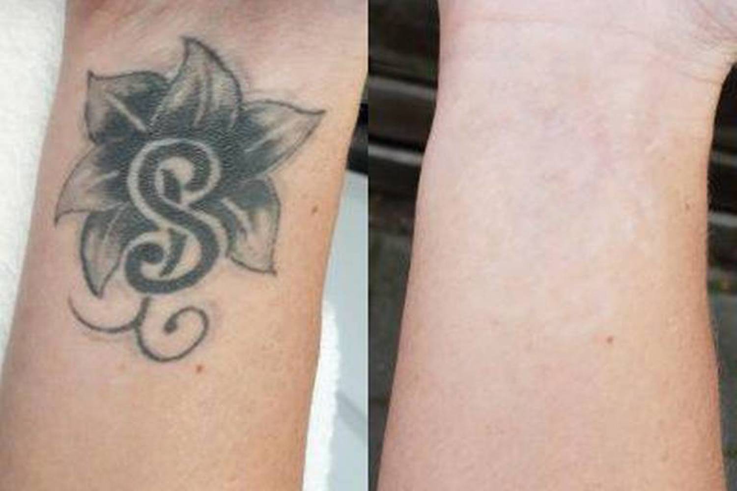 Behandelingtattoo